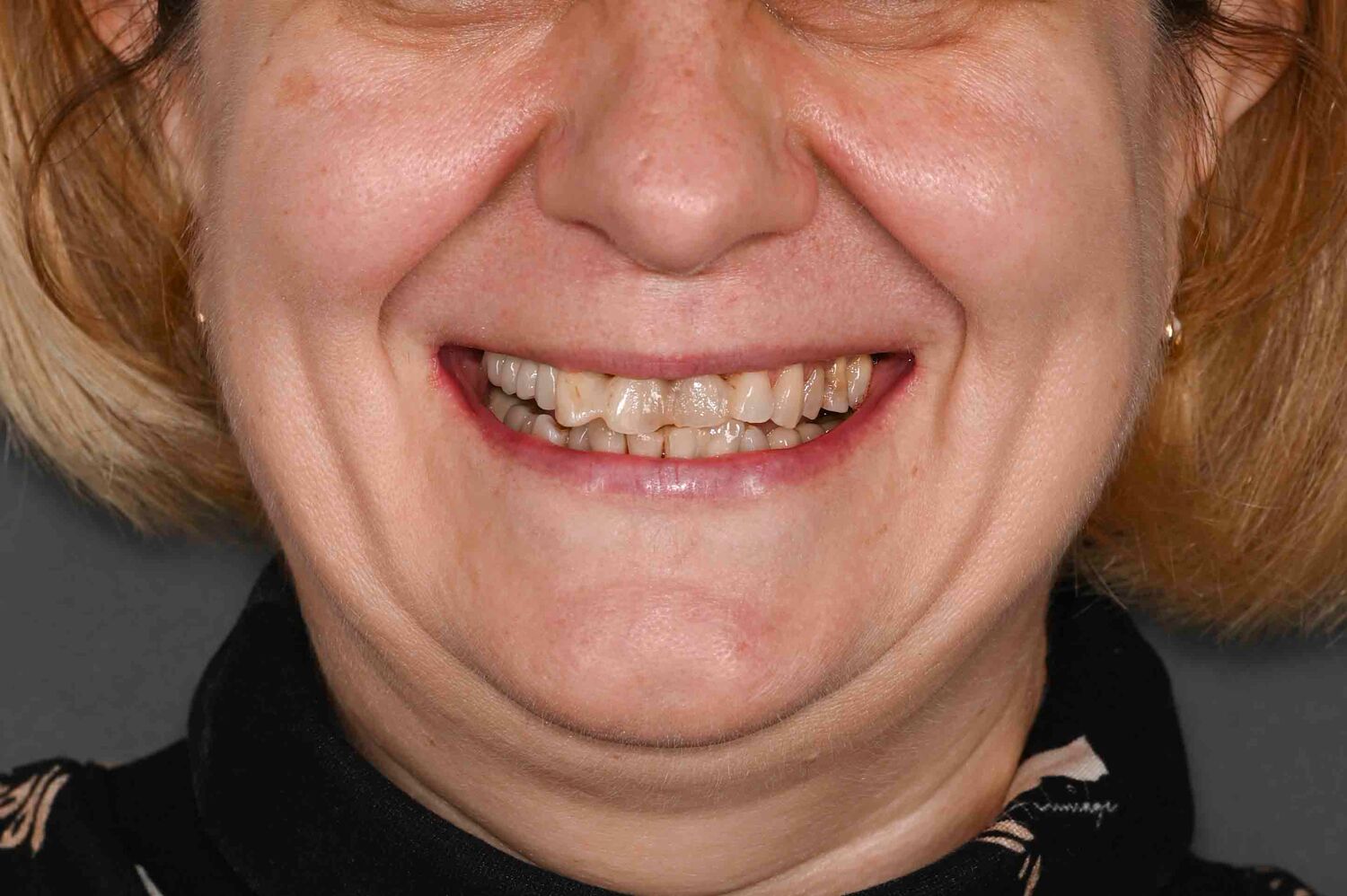 Pacient Clinica Dr. Alin Odor - Rezultat Implantologie